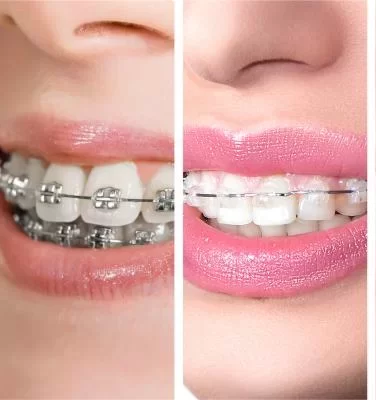Orthodontic Teeth Alignment In Iyyappanthangal