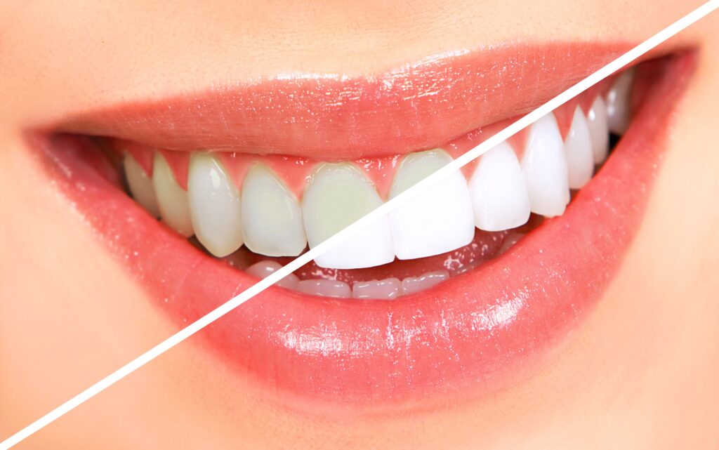 Teeth Bleaching In Iyyappanthangal