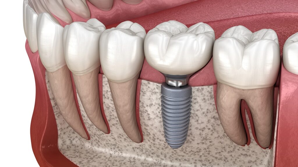 Dental Implants In Iyyappanthangal